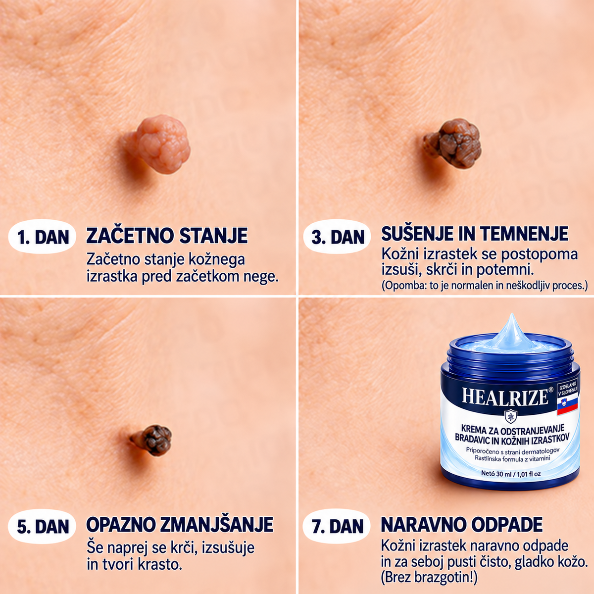 𝐇𝐞𝐚𝐥𝐫𝐢𝐳𝐞® ⭕7-dnevna nega za kožne izrastke in pigmentne madeže (nežna formula brez bolečin – brez brazgotin) 🌿2️⃣